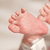 osteopenia-of-prematurity